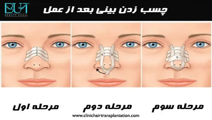 نحوه چسب زدن بینی بعد از عمل رینوپلاستی